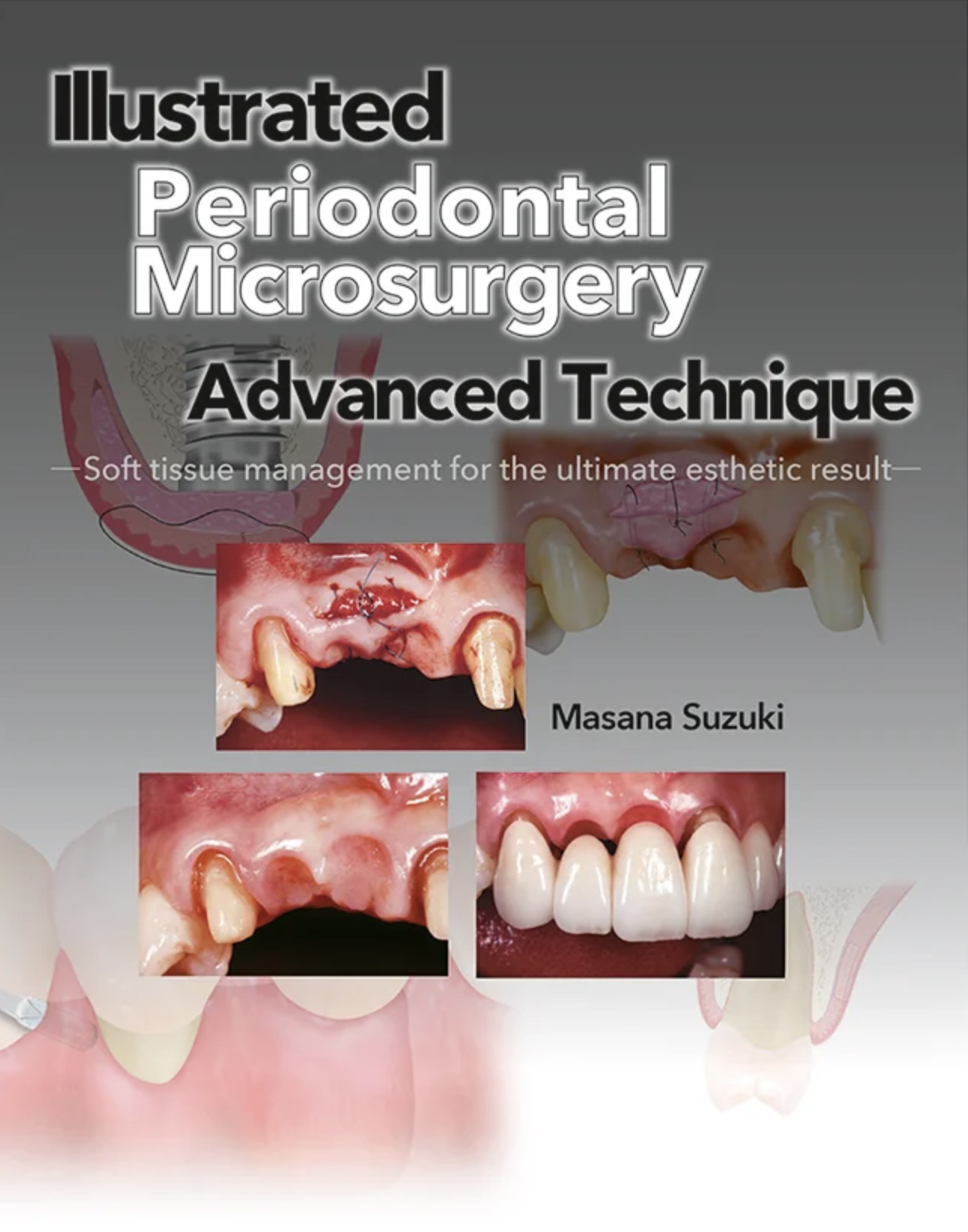 Illustrated Advanced Technique of Periodontal Microsurgery Soft tissue