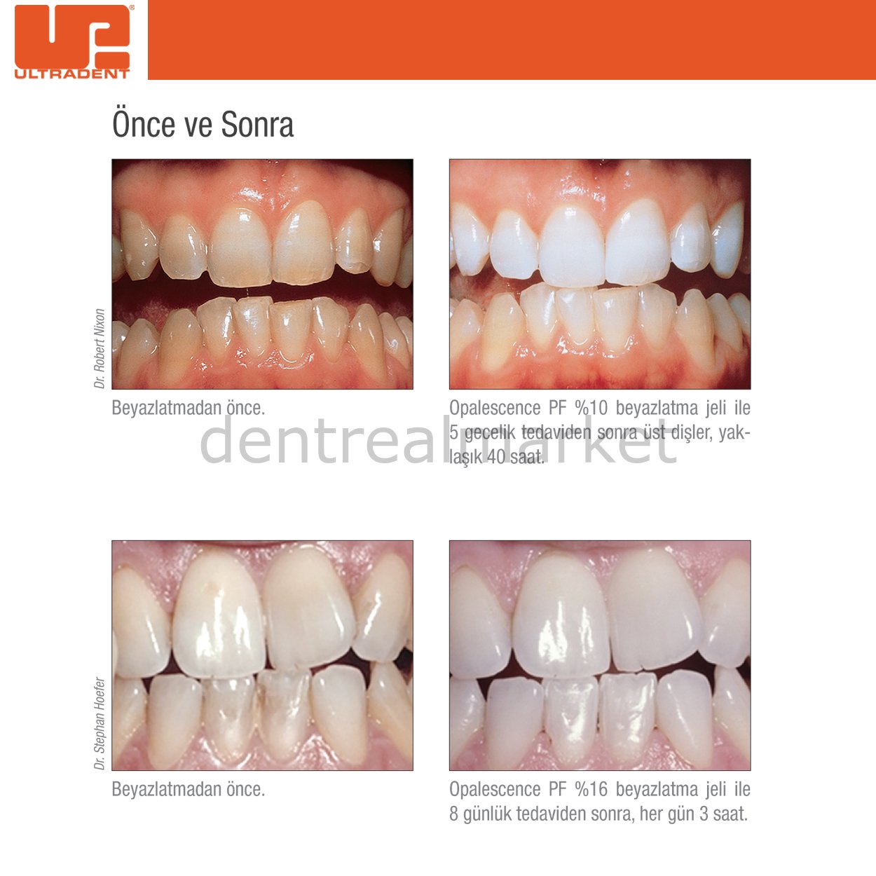 Dentrealmarket Ultradent Ultradent palescence Pf 16 Ev Tipi